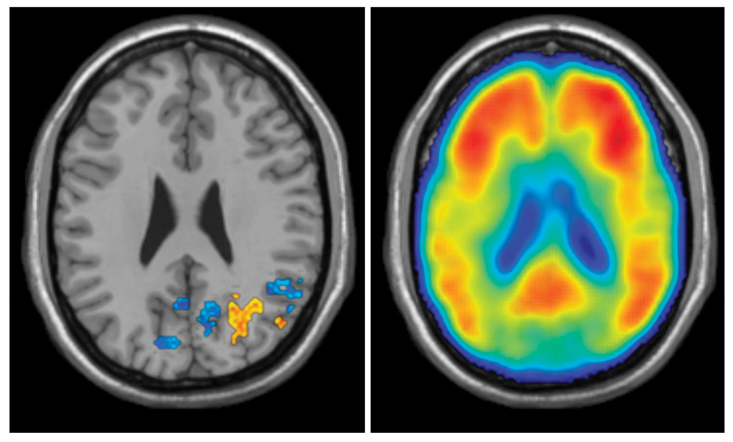 Left: fMRI recordings showed that young people activated orange regions while older people deactivated blue regions during memory formation. Right: PET data showing concentration of amyloid beta (AB) in the brain of older subjects. Regions with high AB (redder colors) correspond to deactivated (blue) regions in the left image. (credit: Jeremy Elman)